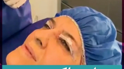 فیلم جراحی پلک با بی حسی موضعی