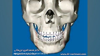 انحراف فک و ارتودنسی و جراحی فک ChIP-Chip