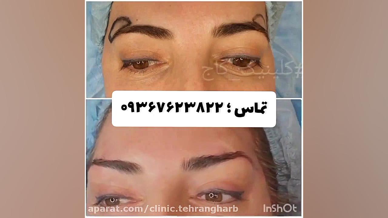 جراحی لیفت ابرو،لیفت شقیقه کاشت مو