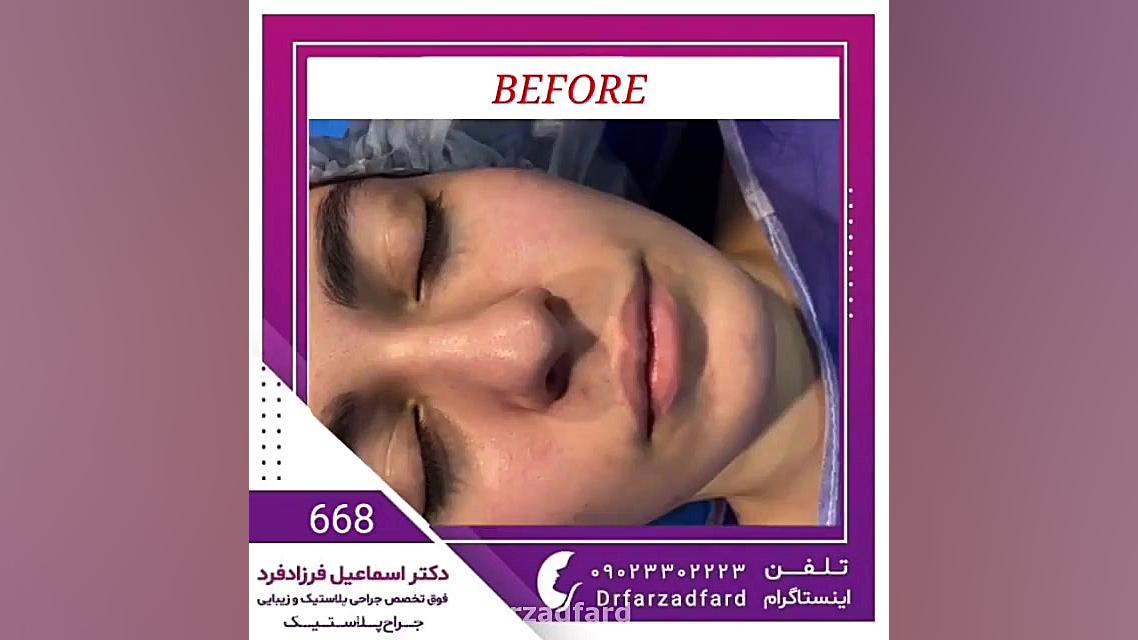 فیلم بدون سانسور و واقعی جراحی بینی در اتاق عمل قبل و بعد از عمل بینی دکتر اسماعیل فرزاد فرد - فوق تخصص پلاستیک