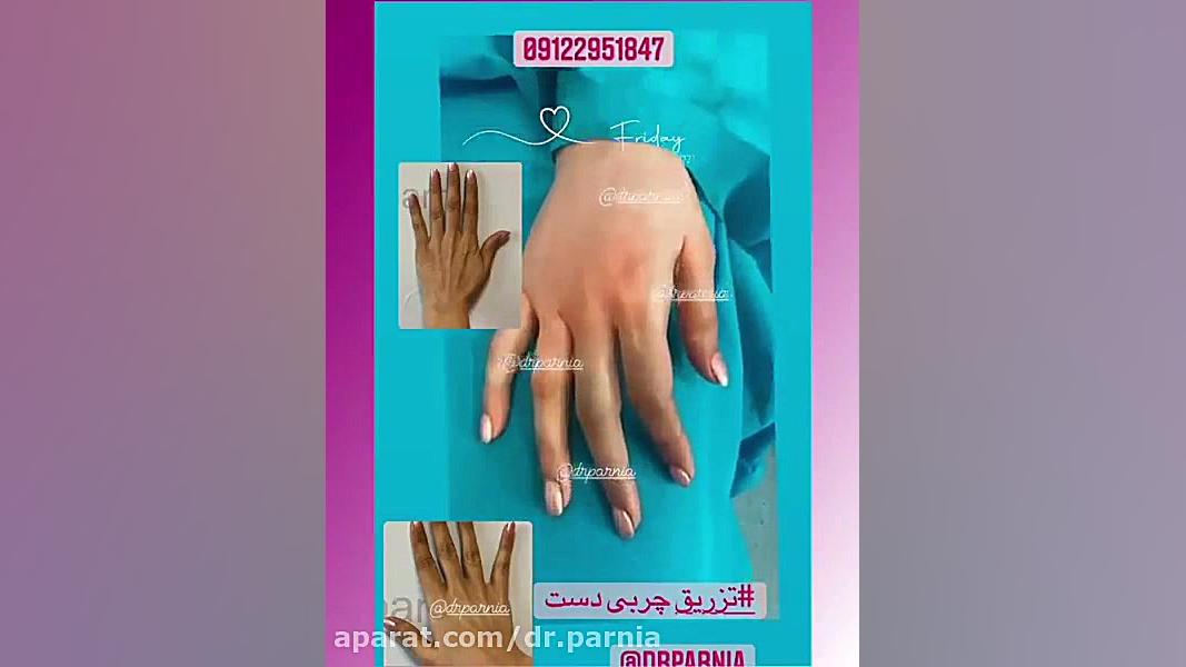 تزریق چربی دست دکتر رفیع پرنیا فوق تخصص پلاستیک