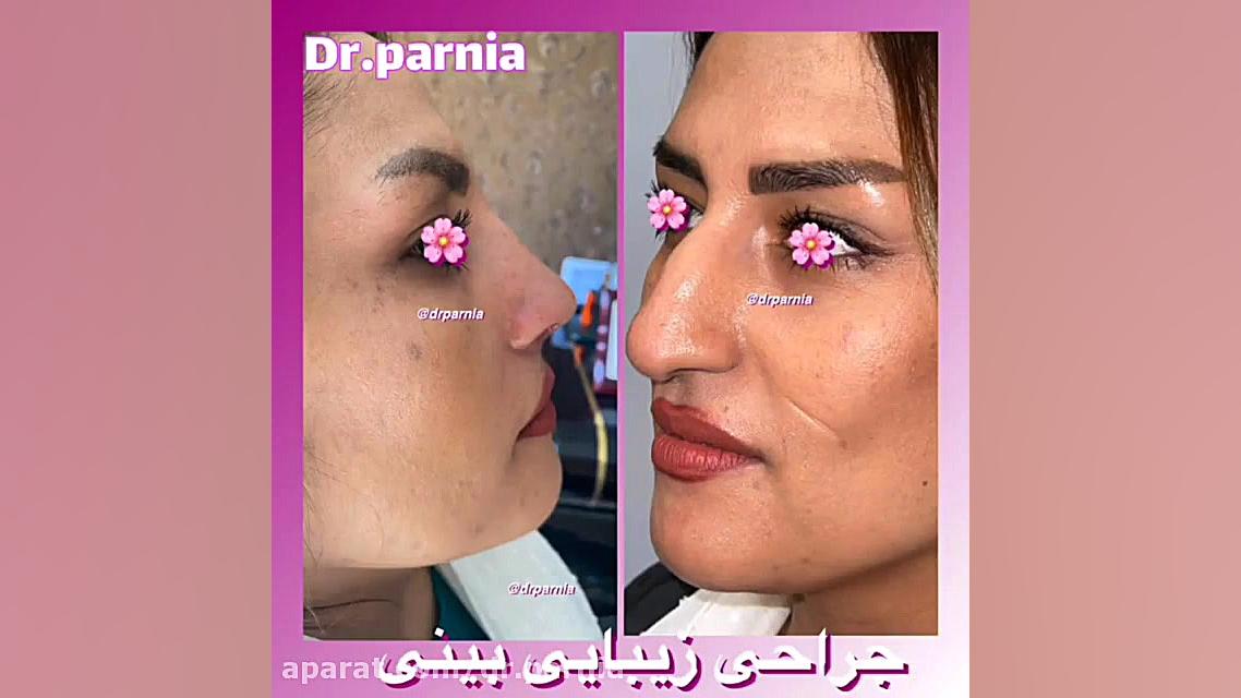 جراحی زیبایی بینی دکتر رفیع پرنیا فوق تخصص پلاستیک