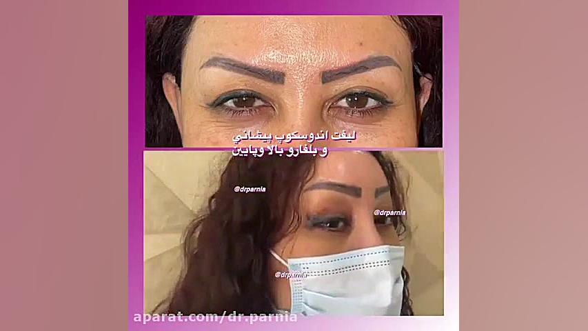 لیفت آندوسکوپ پیشانی و بلفاروپلاستی پلک بالا و پایین دکتر رفیع پرنیا فوق تخصص پلاستیک