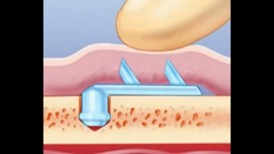 فیلم لیفت پیشانی به روش اندوتاین پلاستیک لثه