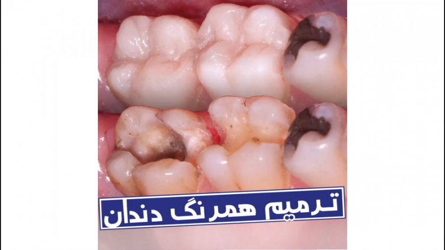 ترمیم هم‌رنگ دندان با استفاده از مواد کامپوزیتی | سیمادنت کابرگولین