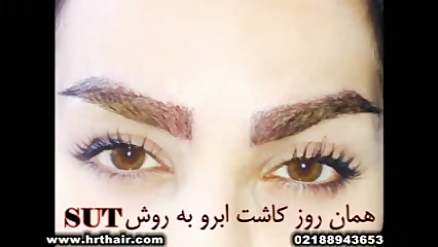 کاشت ابرو - مركز تخصصی موی رنسانس ابرسانی پوست