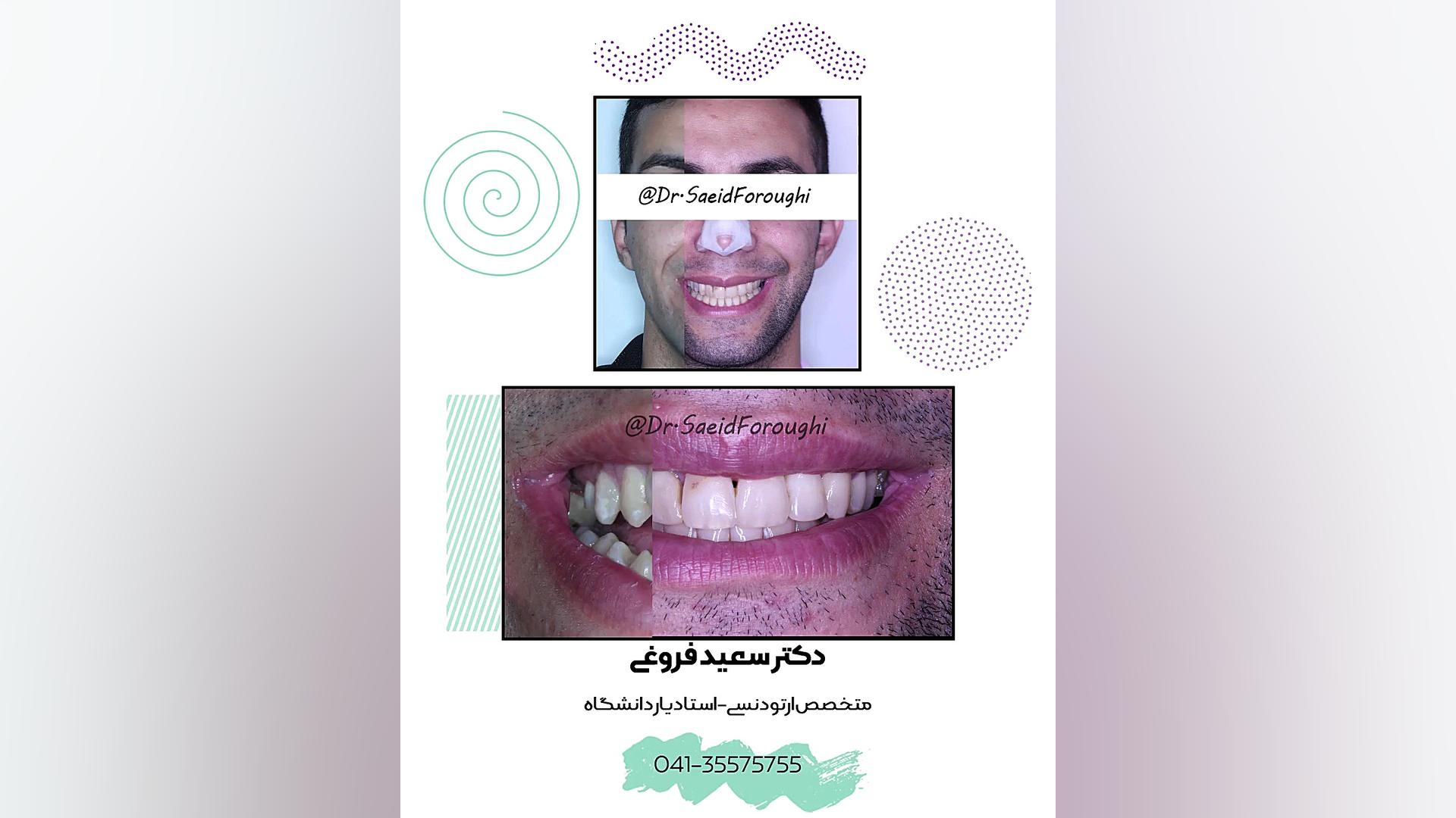 درمان ترکیبی ارتودنسی و جراحی فک دکتر سعید فروغی متخصص ارتودنسی