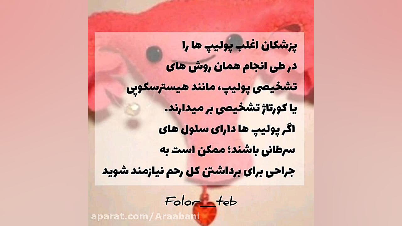 درمان پولیپ رحم سیده سارا موسوی عربانی