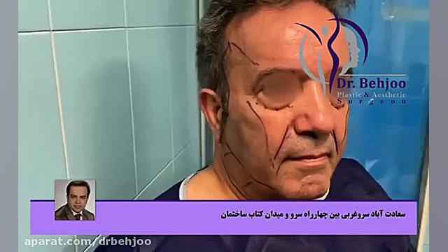 فیلم واقعی لیفت کامل صورت در اتاق عمل دکتر شاهین بهجو - فوق تخصص جراحی پلاستیک