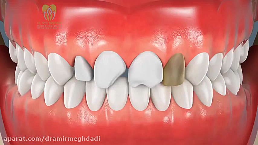 فیلم مراحل انجام لمینت دندان بررسی اروماتاز
