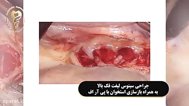 جراحی سینوس لیفت فک بالا به همراه بازسازی استخوان با پی ار اف دکتر علی قمری - متخصص جراحی لثه و ایمپلنت