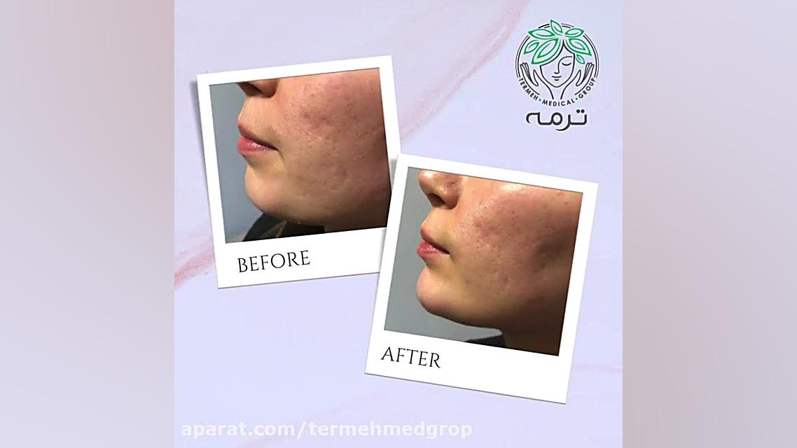 تزریق ژل چانه ابمابوسیکلیب