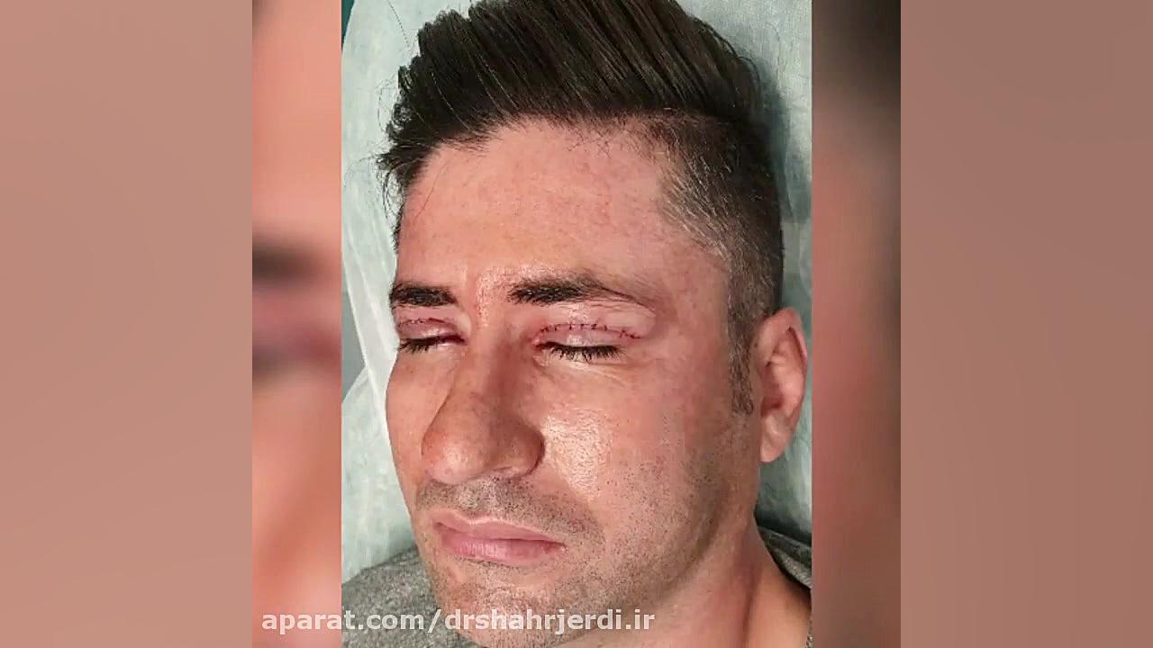 بلفاروپلاستی عملی ساده و سرپایی بلیچینگ