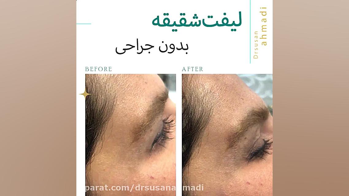 فیلم واقعی لیفت شقیقه بدون جراحی دکتر سوسن احمدی پیر شهید
