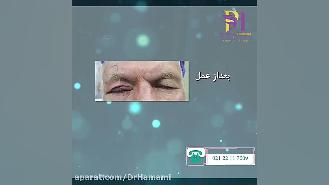 فیلم درمان فلج عصب چشم چاخانچی