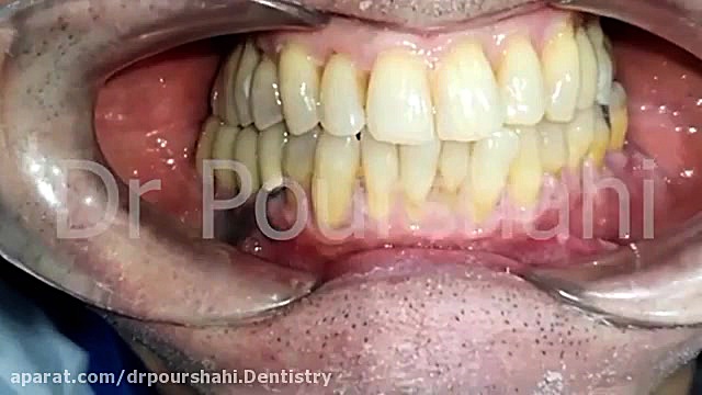 چه کنیم بعد از جرمگیری دندان ها حساس نشوند؟ لیزر موهای زائد