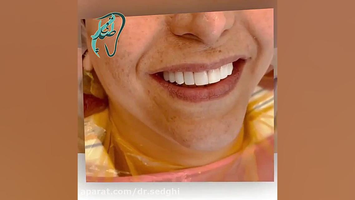 کامپوزیت ونیر ده دندان فک بالا و ده دندان فک پایین . پریودنتیکس