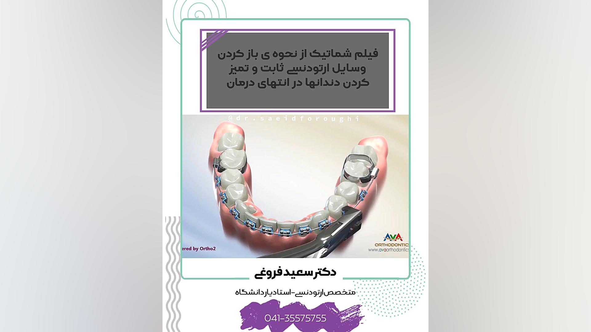 فیلم شماتیک از نحوه ی باز کردن وسایل ارتودنسی ثابت و تمیز کردن دندانها در انتهای دکتر سعید فروغی متخصص ارتودنسی