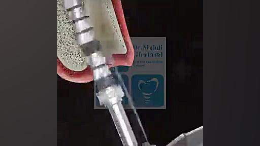 ویدئو جذاب از جراحی کاشت ایمپلنت ( دکتر مهدی غلامی) دکتر مهدی غلامی