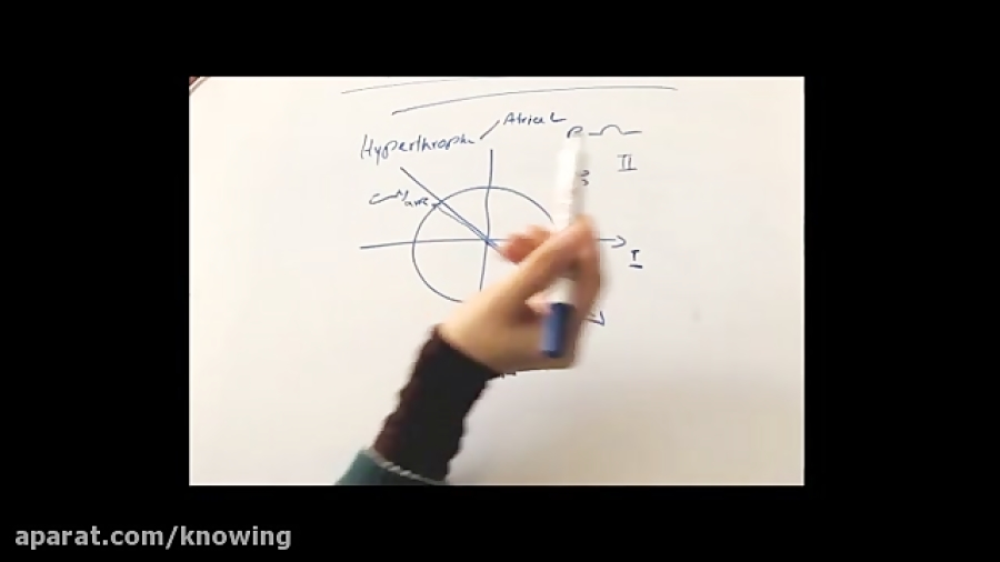 تفسیر ECG (هیپر تروفی دهلیز) کلینیک زیبایی