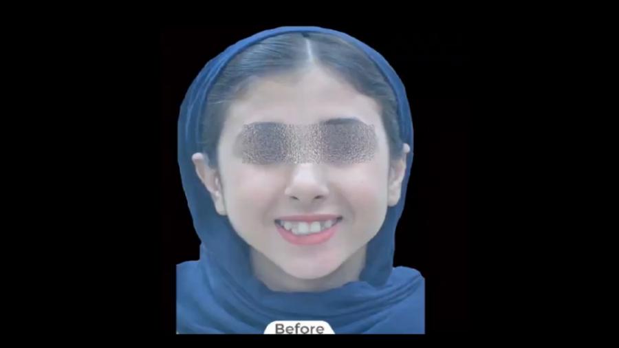 درمان ارتودنسی ثابت دوفک بدون کشیدن دندان دائمی دکتر برهمن سبزواری - متخصص ارتودنسی - مشهد