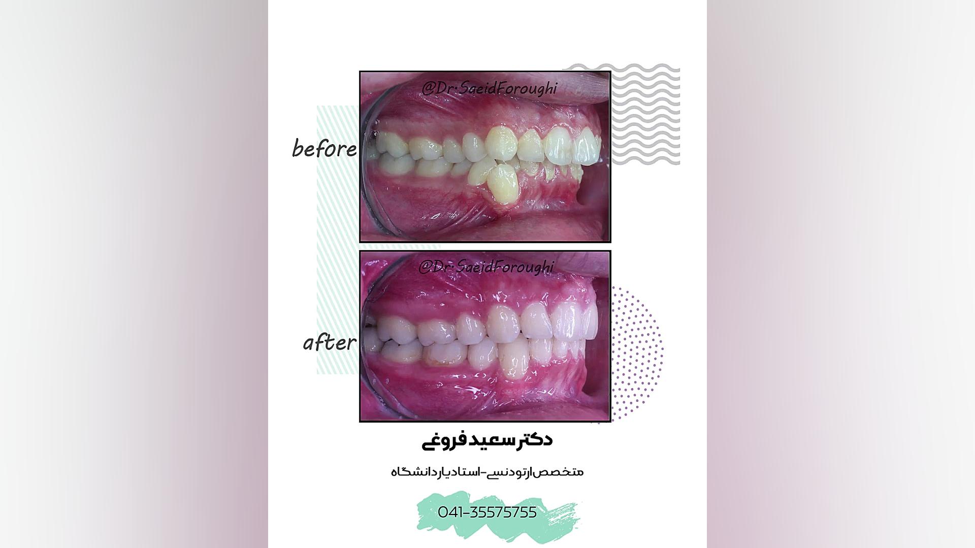 درمان بی نظمی شدید دندان های دوفک و خارج از قوس بودن دندان نیش فک پایین و تصحیح دکتر سعید فروغی متخصص ارتودنسی