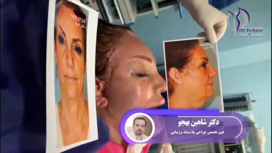 فیلم کامل لیفت اندوسکوپیک پیشانی و ابرو و تزریق چربی به دست دکتر شاهین بهجو - فوق تخصص جراحی پلاستیک