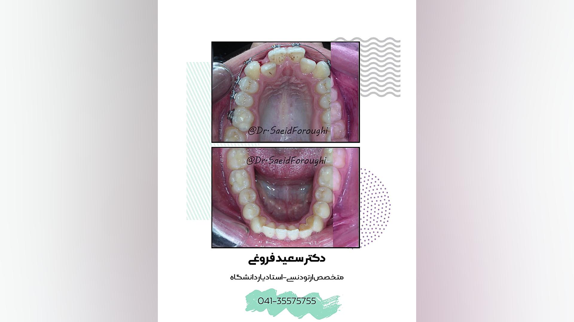 رفع تداخل دندانی فک بالا و پایین و ردیف کردن و چفت کردن دندانهای دو فک توسط ارتو دکتر سعید فروغی متخصص ارتودنسی