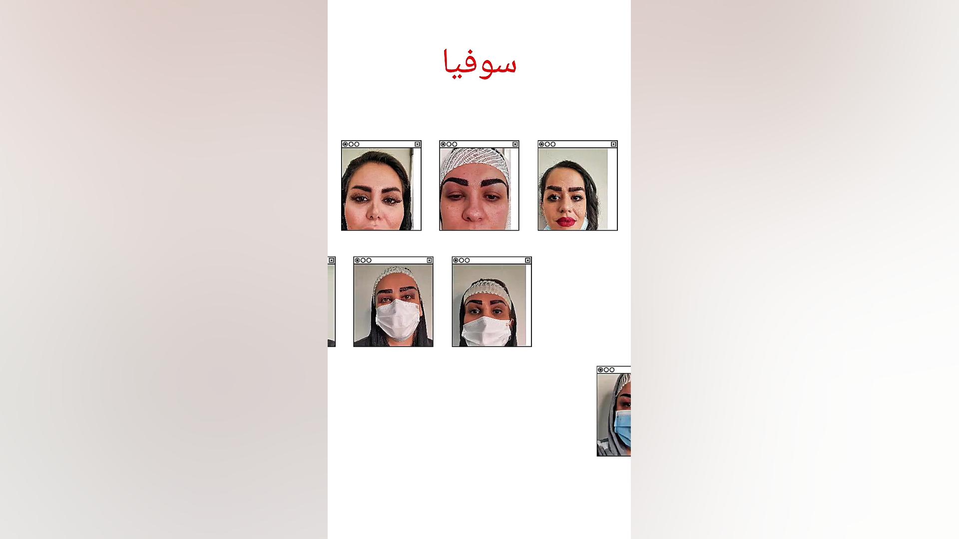 کاشت ابرو 16 ( مرکز تخصصی کاشت مو / ابرو لیان ) گالکانی زوماب