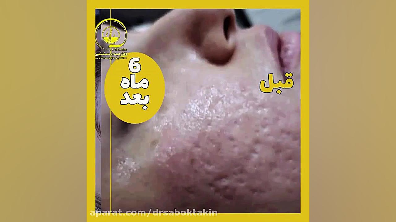 درمان جای جوش و اسکار آکنه متخصص پوست اصفهان دکتر مهدی سبکتکین