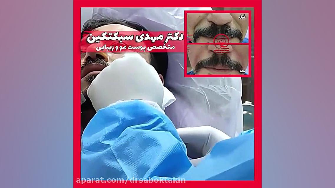 ژل خط خنده متخصص پوست اصفهان دکتر مهدی سبکتکین