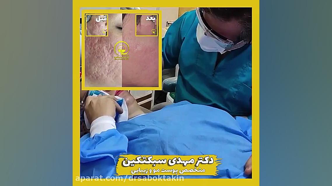 درمان قطعی اسکار آکنه متخصص پوست اصفهان دکتر مهدی سبکتکین