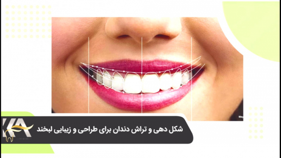 شکل دهی و تراش دندان برای طراحی و زیبایی لبخند دکتر کامیار عباسی