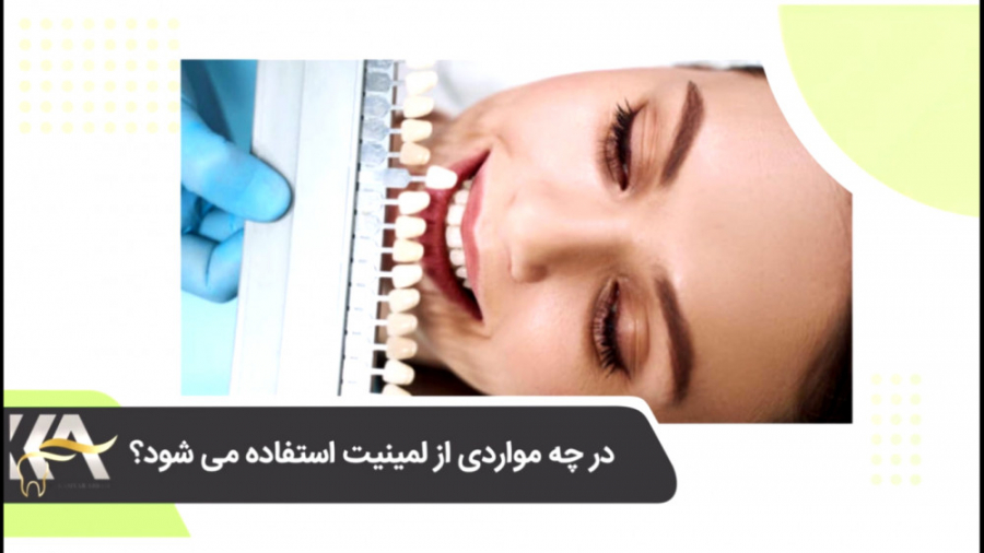 دانستنی های لمینت دندان دکتر کامیار عباسی