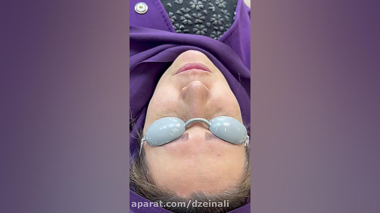 بهبود بسیار خوب لکهای زیر چشم و گونه با انجام لیزر دکتر فرحناز زینعلی - متخصص پوست، مو، زیبایی زنجان