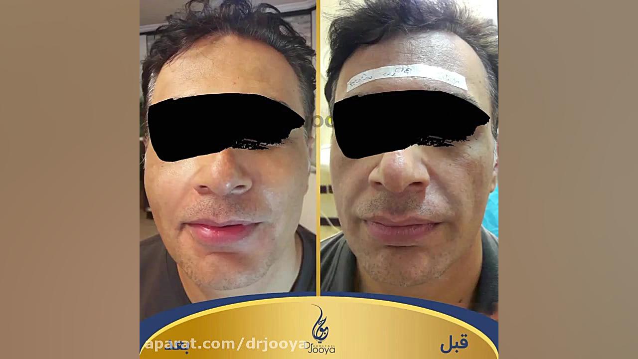 نمونه کار زیبایی توسط دکتر جویا متخصص پوست اصفهان دکتر ابوالفضل جویا