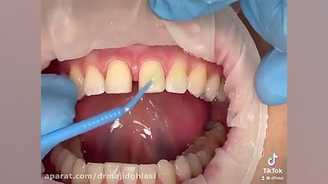 حذف فاصله بین دندانها دکترمجیدقیاسی