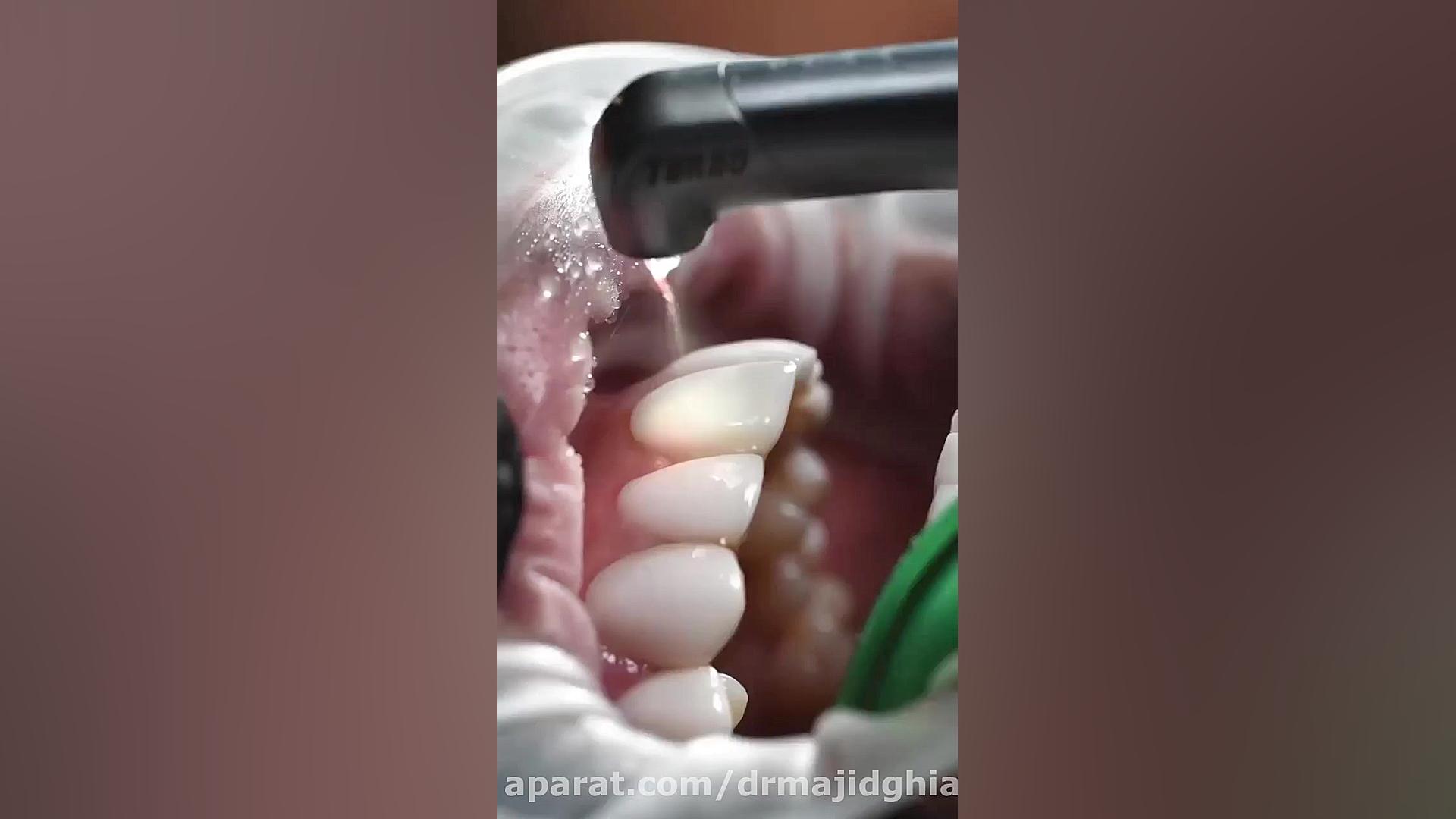 حدف ونیر قبلی و جایگزین کردن آن با ونیر جدید دکترمجیدقیاسی