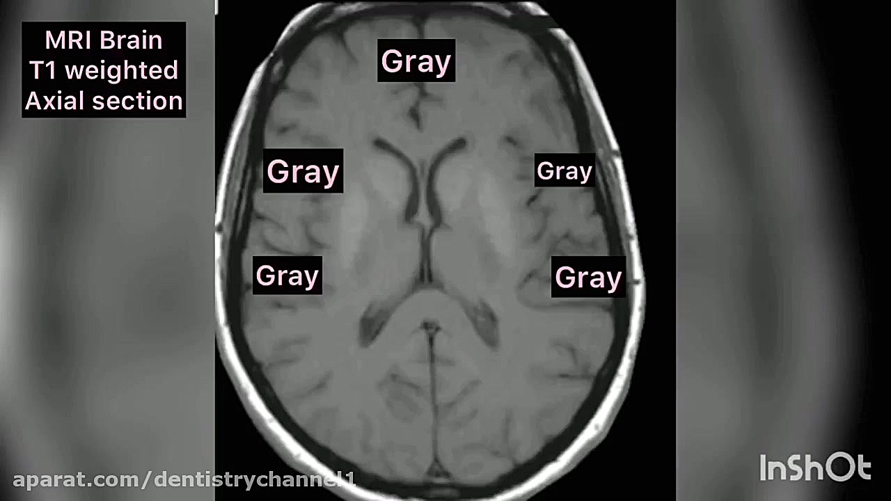جلسه دوم MRI ( دکتر اخشته ) بررسی لک صورت