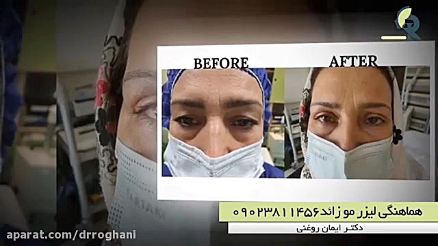 یک هفته بعد از بلفاروپلاستی دکتر ایمان روغنی جراح و متخصص پوست و مو