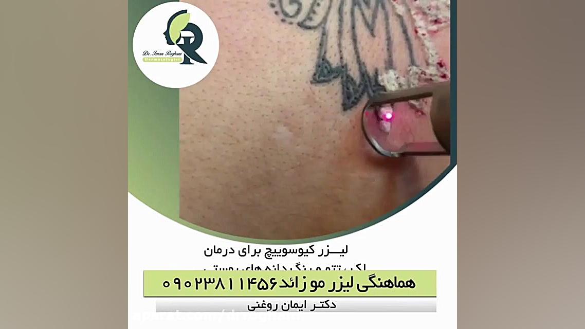 لیزر کیوسوئیچ دکتر ایمان روغنی جراح و متخصص پوست و مو