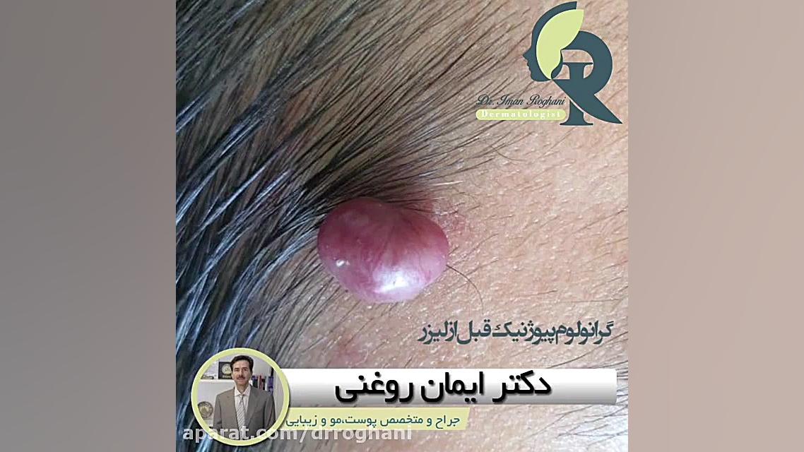درمان گرانولوم پیوژنیک با لیزر دکتر ایمان روغنی جراح و متخصص پوست و مو