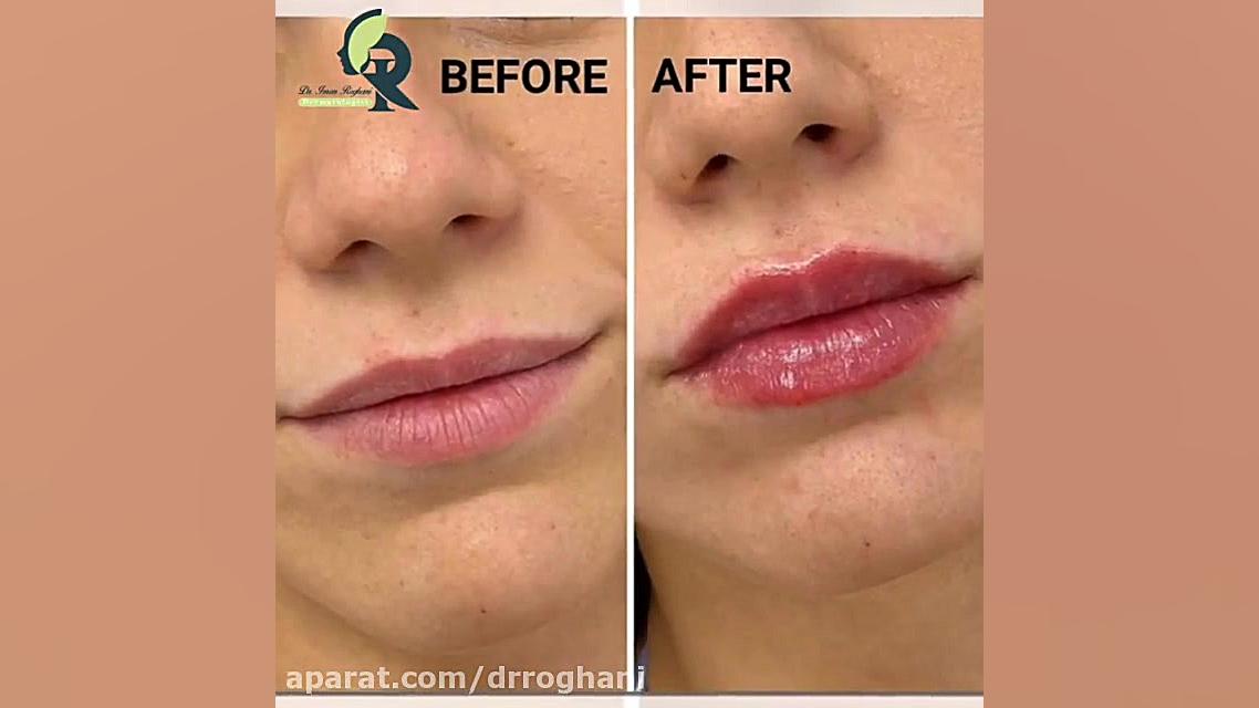 تزریق ژل لب دکتر ایمان روغنی جراح و متخصص پوست و مو