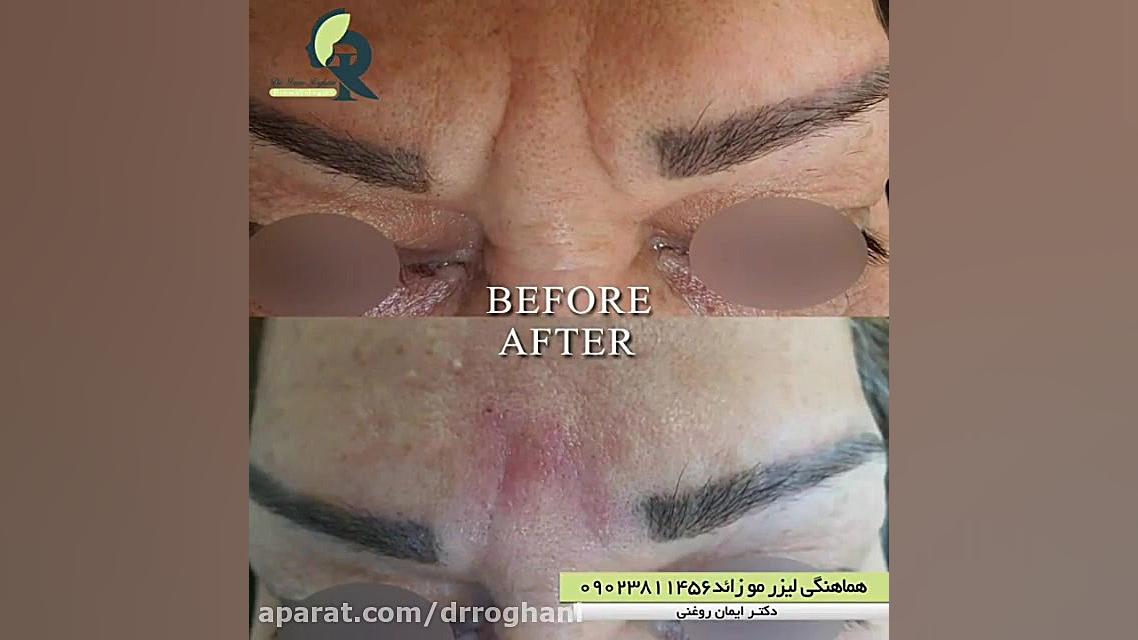 تزریق ژل خط اخم دکتر ایمان روغنی جراح و متخصص پوست و مو