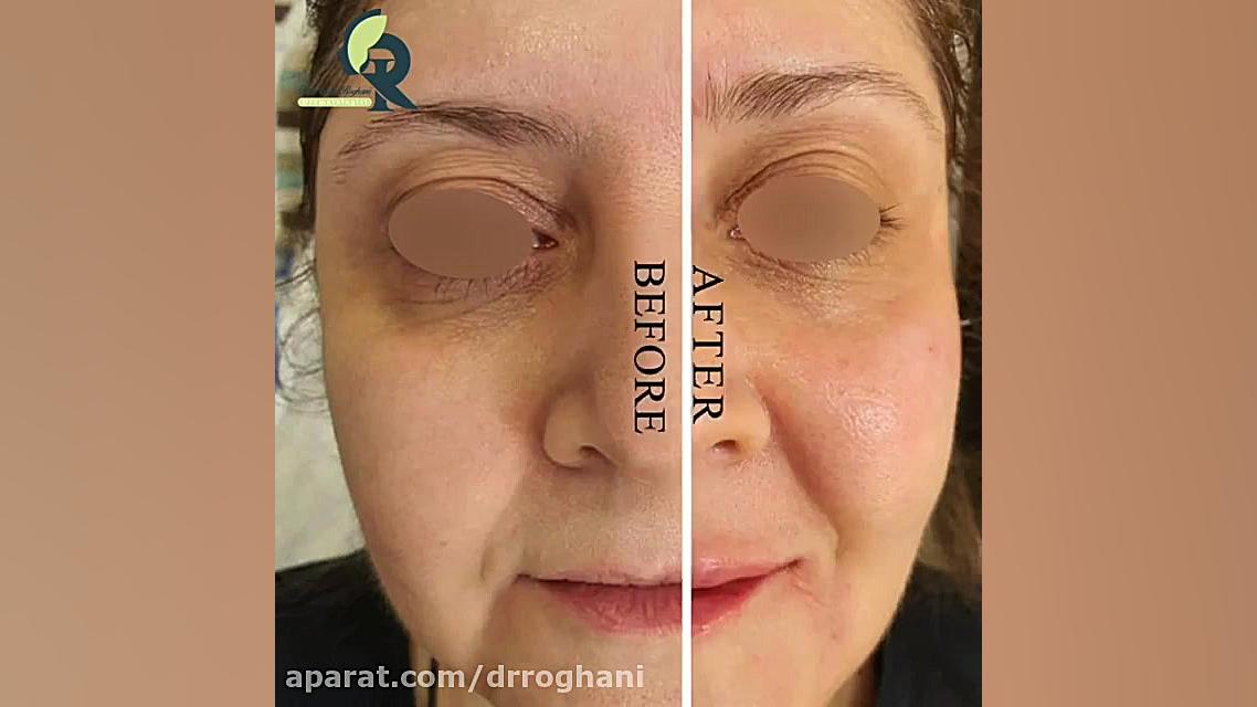 بعد از تزریق ژل برای سه ناحیه زیر چشم ، لب و خط خنده دکتر ایمان روغنی جراح و متخصص پوست و مو