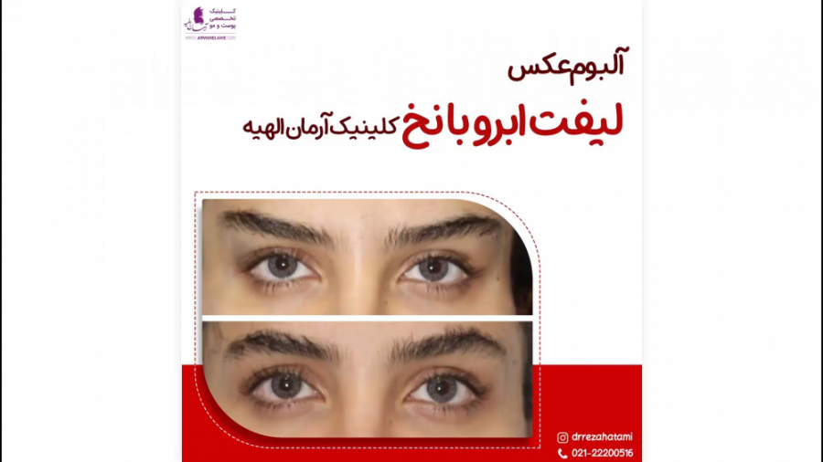 لیفت ابرو با نخ کاردیومگالی