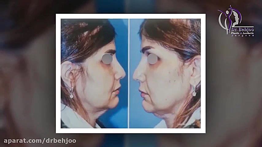 فیلم واقعی لیفت اندوسکوپی پیشانی و صورت و جراحی زیبایی بینی کلینیک لیزر