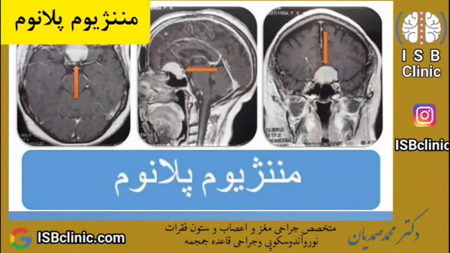 مننژیوم پلانوم و توبرکولوم سِلا آر اف فرکشنال