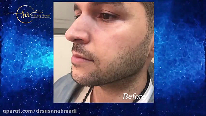 فیلم کامل زاویه سازی صورت با تزریق فیلر در مراجعه کننده آقا دکتر سوسن احمدی پیر شهید