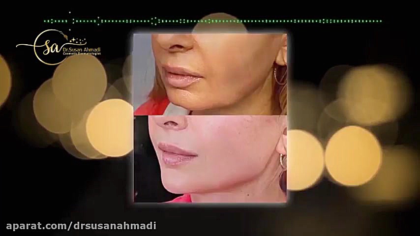 فیلم واقعی زاویه سازی صورت با فیلر عمل زیبایی